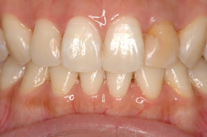 前歯の変色　ホワイトニング