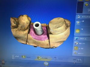 インプラント　口腔内スキャン