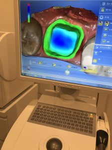 セレック　歯科医師の治療技術