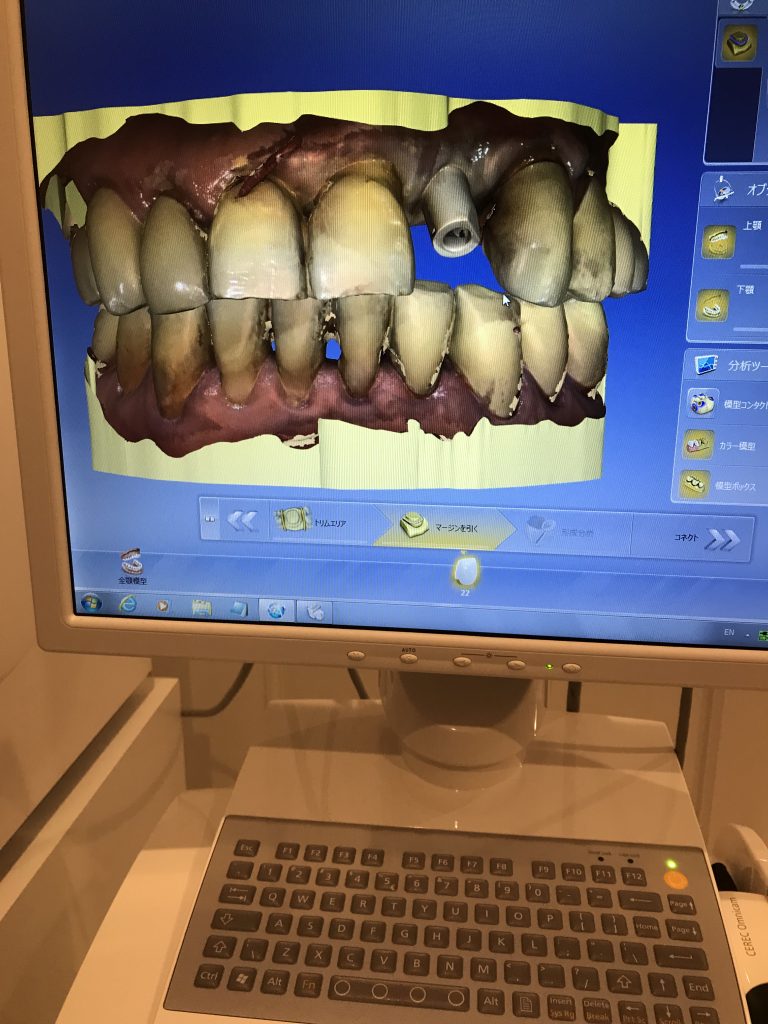印象採得　口腔内スキャン