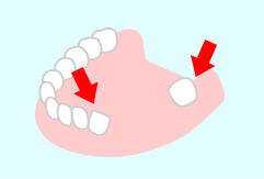 隣の歯への影響