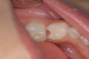 こどもの歯（乳歯）の虫歯　小児歯科