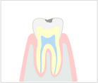 軽度のむし歯