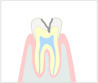 中度のむし歯