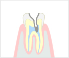 重度のむし歯