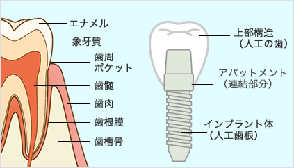 インプラントとは