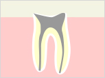 重度のむし歯の場合