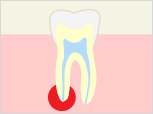 歯根の病気がひどい場合