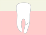 歯根が折れた場合