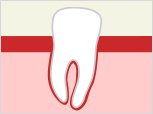 重度の歯周病の場合