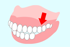 反対の歯への影響