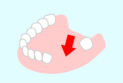 歯茎や咬み合わせへの影響
