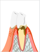 軽度歯周炎